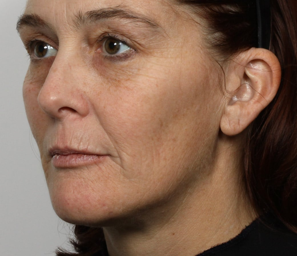 after 6 weeks using iaura sculptor