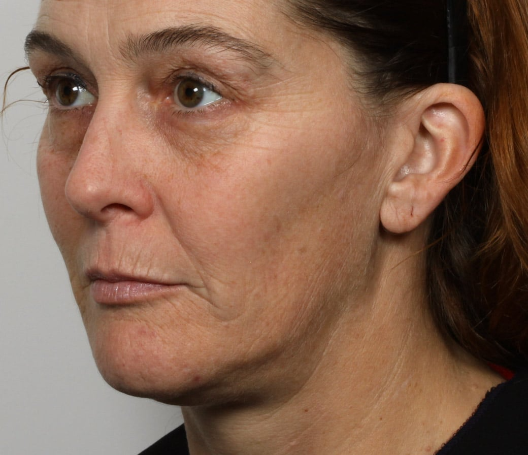 before 6 weeks using iaura sculptor