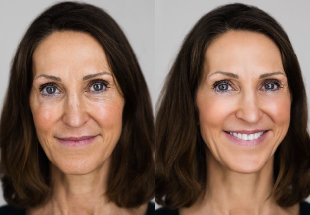 Photo showing face on one day 1 of using the iAura Facial Sculptor and a comparison side by side of her face on day 30 showing improvements to her cheeck marks