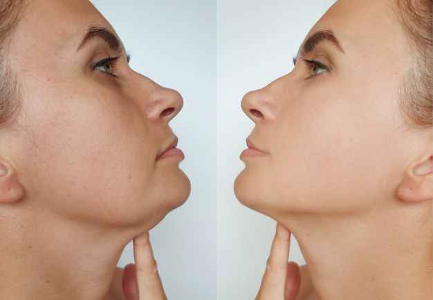 Photo showing face on one day 1 of using the iAura Facial Sculptor and a comparison side by side of her face on day 30 showing improvements to her Double Chin