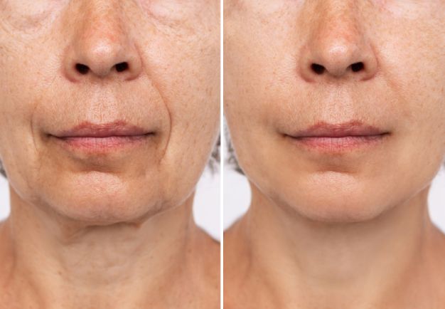 Photo showing face on one day 1 of using the iAura Facial Sculptor and a comparison side by side of her face on day 45 showing improvements to her Wrinkles