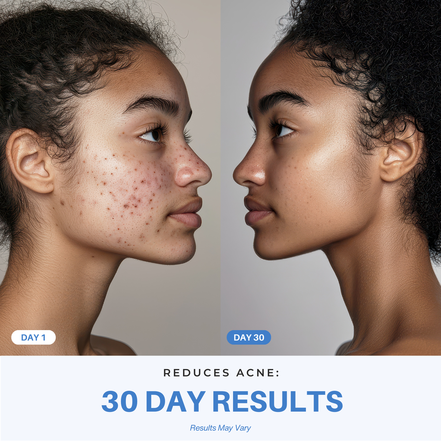 iAura Reduces Acne 30 Day Results